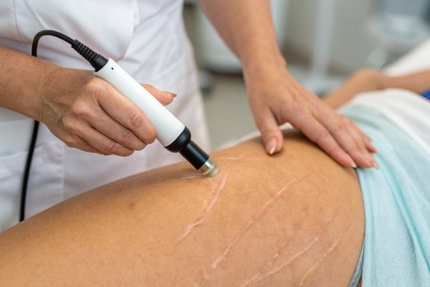 Ультразвуковая терапия на бедре для уменьшения целлюлита